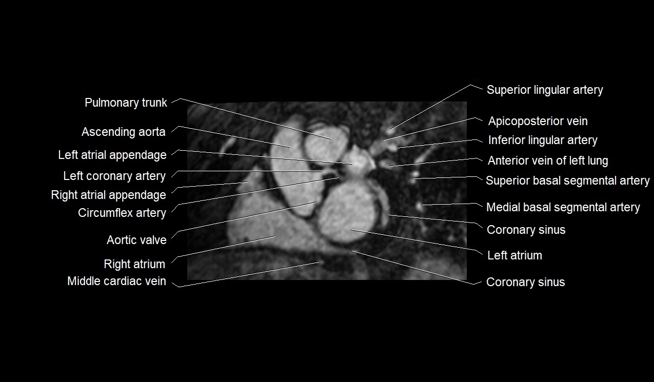 MRI heart and coronary arteries short axis anatomy image 15.webp